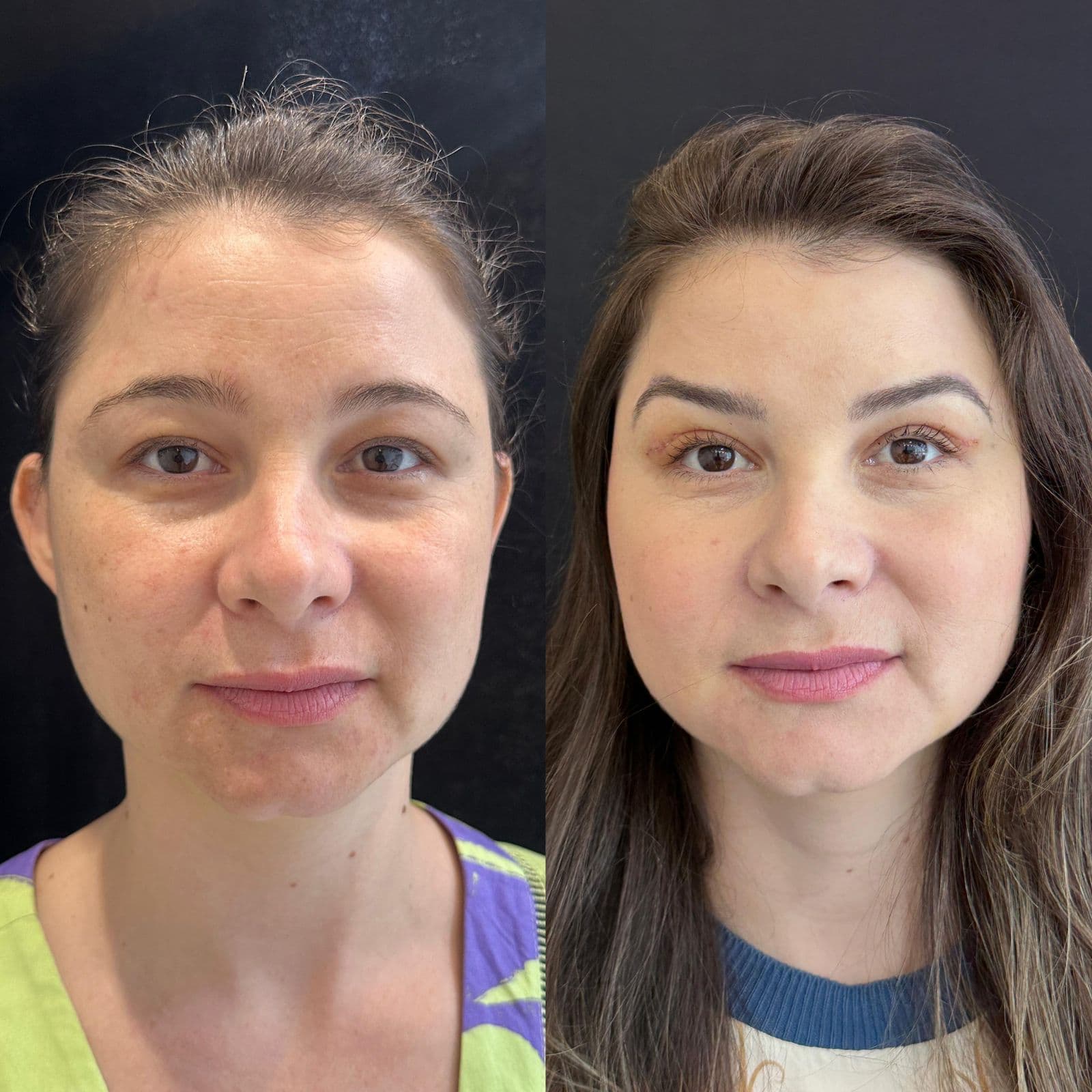 Blefaroplastia