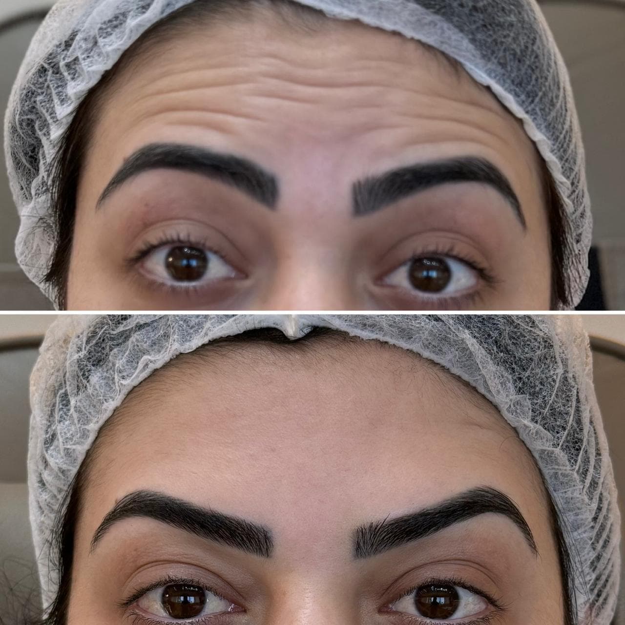 Botox