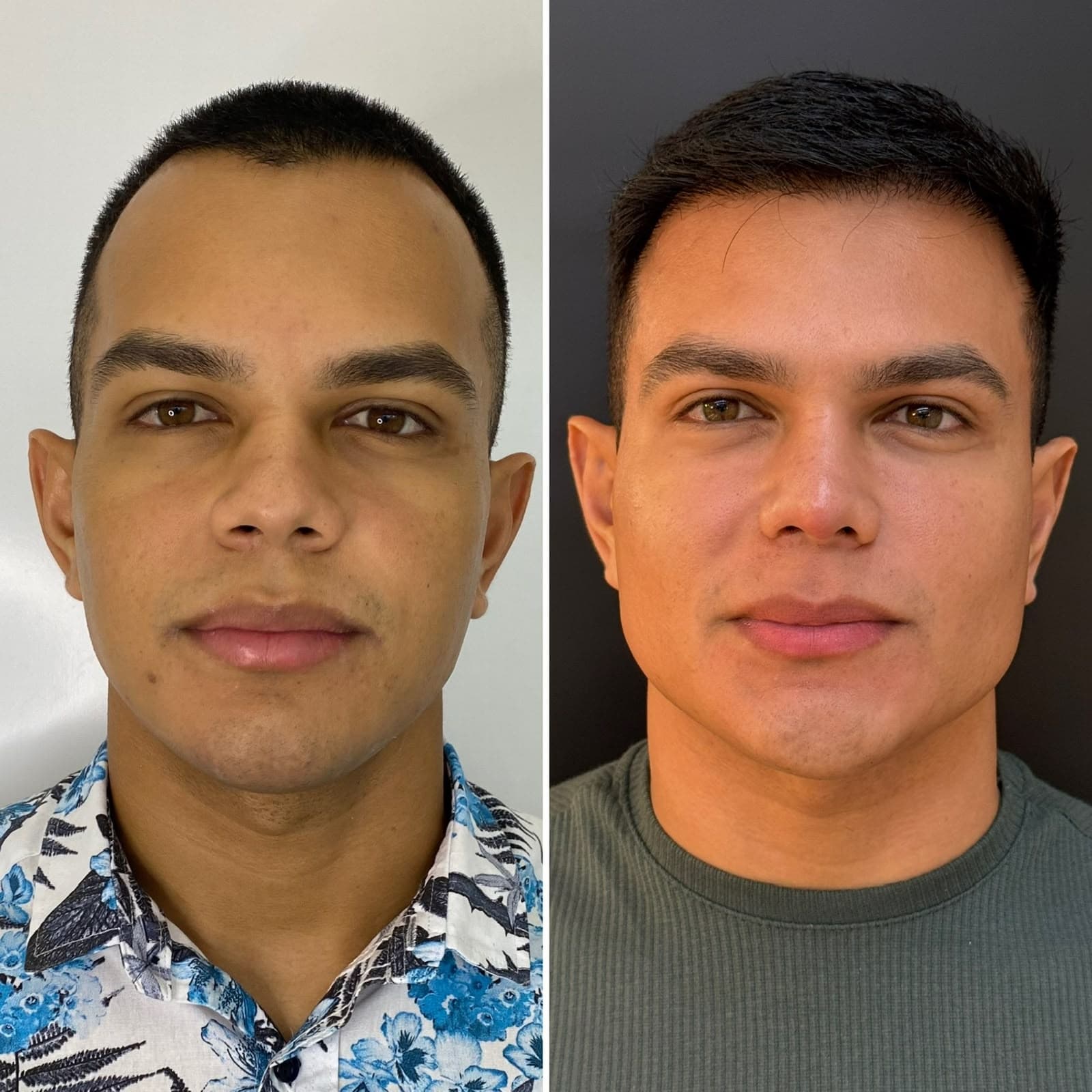 Harmonização Facial